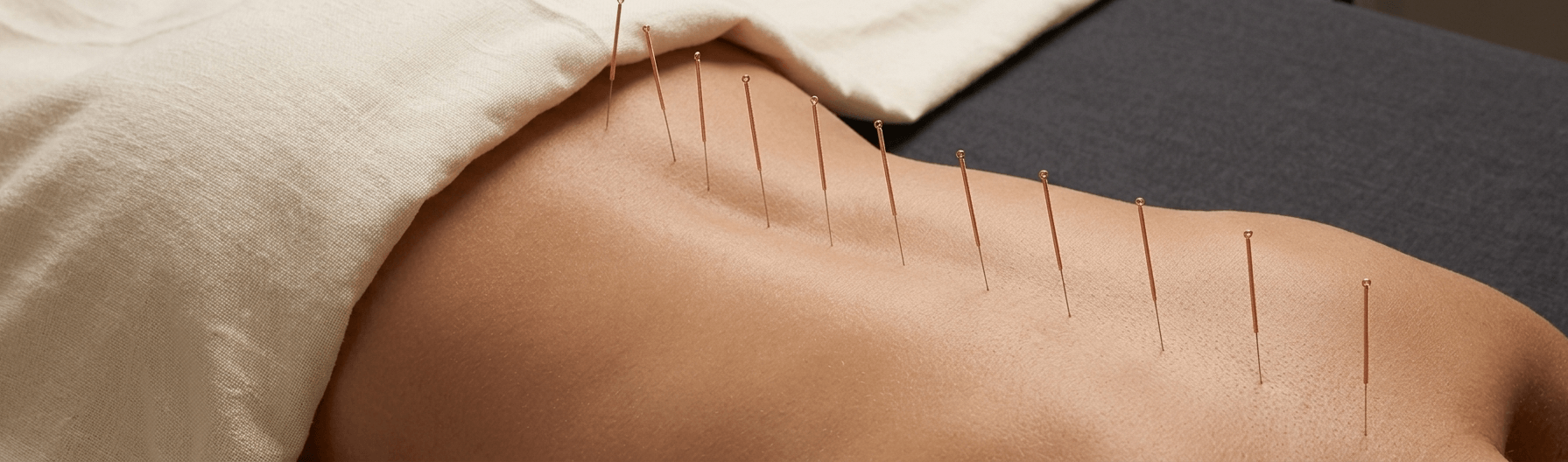 akupunktur